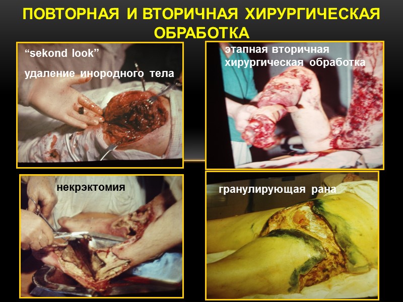 ПОВТОРНАЯ И ВТОРИЧНАЯ ХИРУРГИЧЕСКАЯ ОБРАБОТКА некрэктомия этапная вторичная  хирургическая обработка “sekond look” удаление